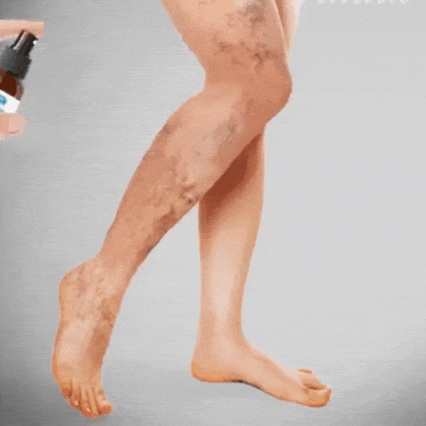 Elimina las varices y siente el alivio